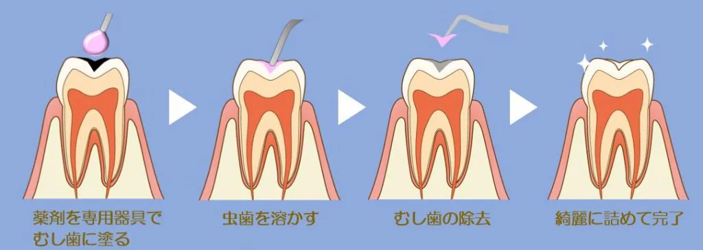 虫歯以外のところは削らないでほしい ドリルの音を聞くと怖くなる そんなあなたに削らない虫歯治療 高崎ヒロデンタルクリニック